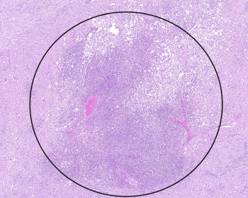 Microabscess in white matter of brain (circle); Acute vasculitis (box)